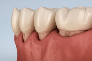 Digital image of periodontal pockets